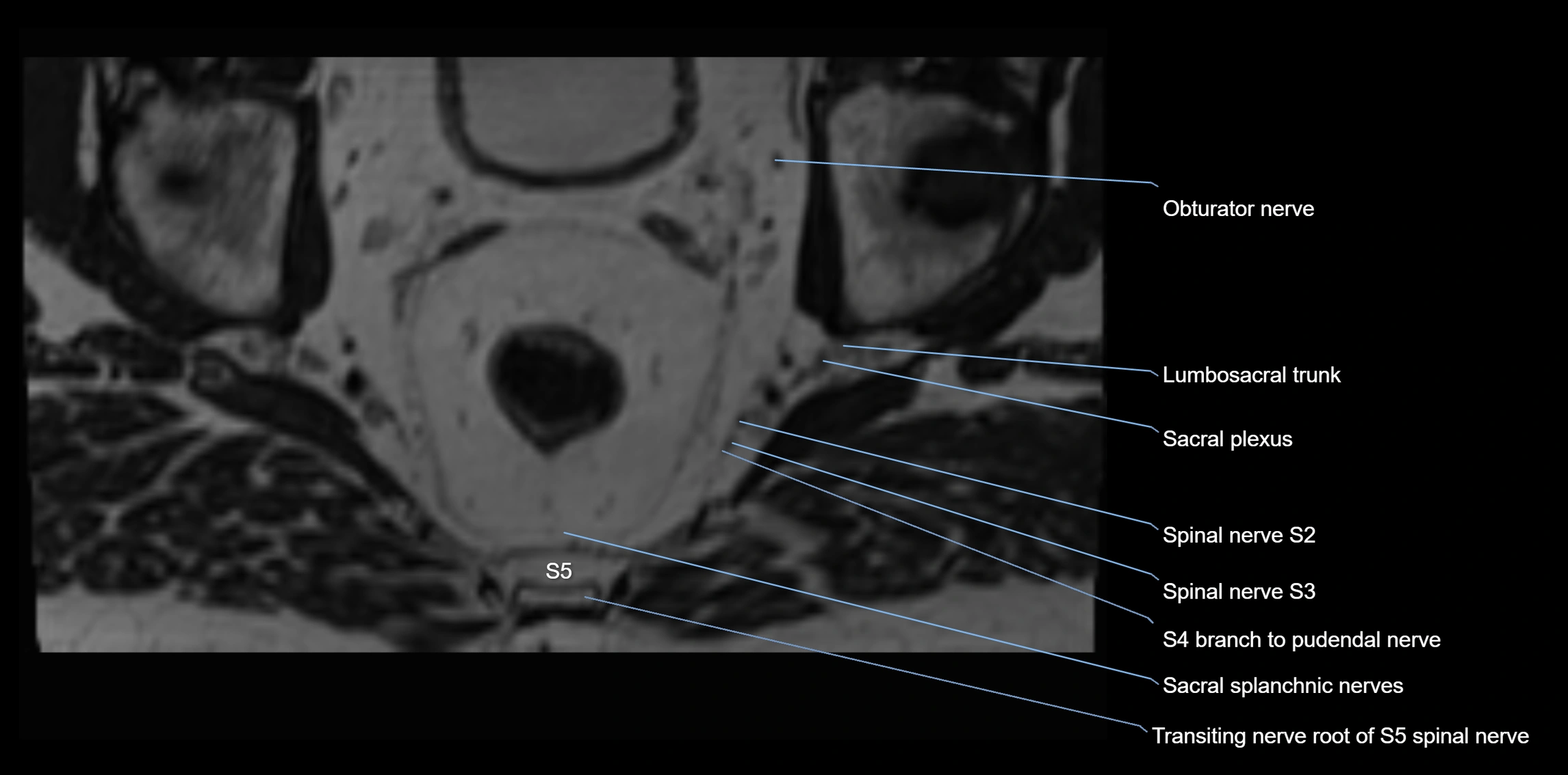 MR lumbosacral plexus axial cross sectional anatomy 3T  radiology  image-img-1008001-00109.webp